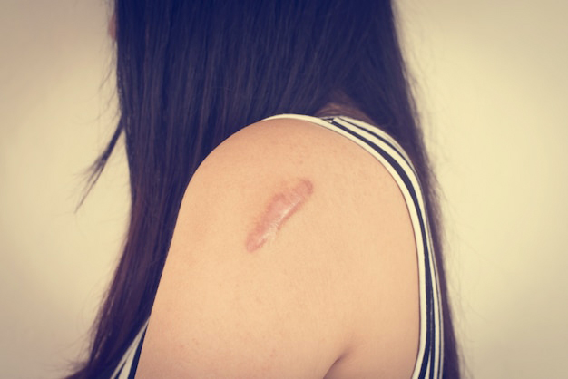 woman-with-scar-her-arm_1253-97(1).jpg