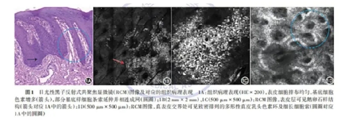 学术前沿丨常见非黑素细胞性皮肤肿瘤的反射式共聚焦显微镜特征专家共识（2025版）-04.jpg