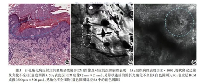 学术前沿丨常见非黑素细胞性皮肤肿瘤的反射式共聚焦显微镜特征专家共识（2025版）-08.jpg