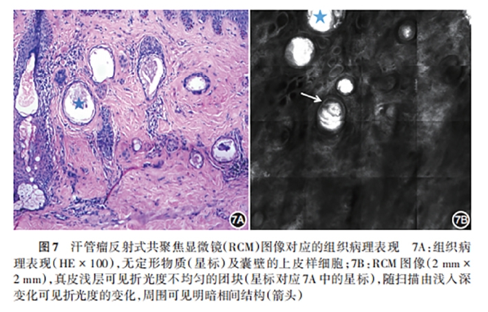 学术前沿丨常见非黑素细胞性皮肤肿瘤的反射式共聚焦显微镜特征专家共识（2025版）-10.jpg