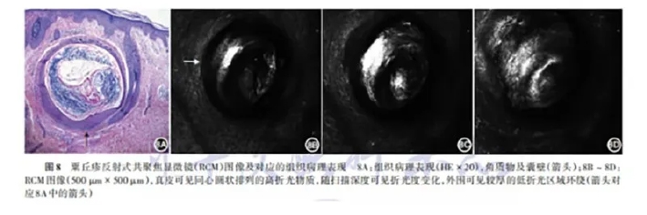 学术前沿丨常见非黑素细胞性皮肤肿瘤的反射式共聚焦显微镜特征专家共识（2025版）-11.jpg