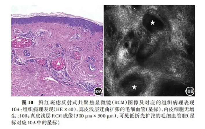 学术前沿丨常见非黑素细胞性皮肤肿瘤的反射式共聚焦显微镜特征专家共识（2025版）-13.jpg