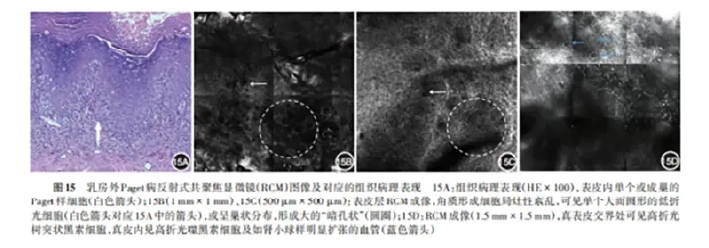 学术前沿丨常见非黑素细胞性皮肤肿瘤的反射式共聚焦显微镜特征专家共识（2025版）-19.jpg