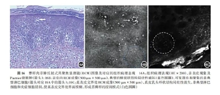 学术前沿丨常见非黑素细胞性皮肤肿瘤的反射式共聚焦显微镜特征专家共识（2025版）-20.jpg